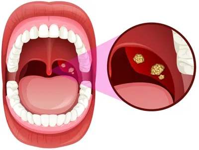 Острый тонзиллит (ангина) у взрослых - симптомы, диагностика, лечение