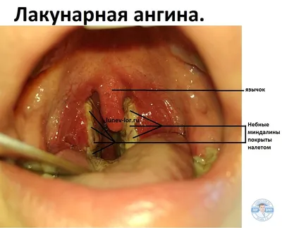 Тонзиллит - симптомы, диагностика, лечение, профилактика | MedKontrol  Маріуполь