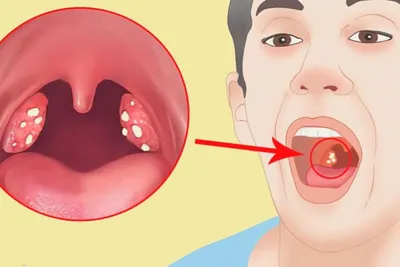 Тонзиллит у взрослых: симптомы, лечение, профилактика в домашних условиях