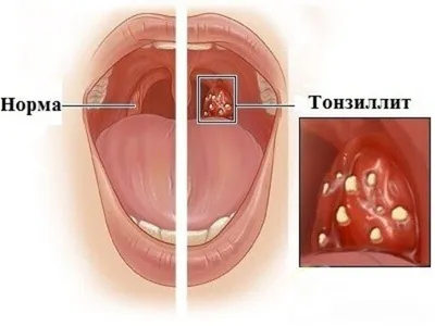 Тонзиллит у детей - причины, симптомы, лечение в клинике «Будь Здоров»