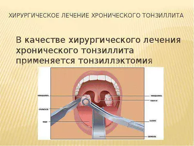 Хронический тонзиллит: симптомы и лечение