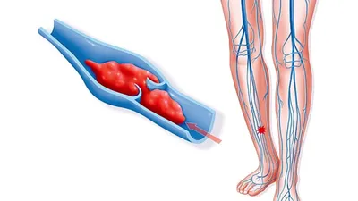 Тромбофлебит - диагностика и лечение в 100med