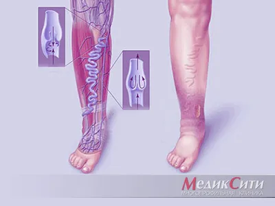 Тромбофлебит — причины, симптомы, диагностика и лечение тромбофлебита вен  нижних конечностей