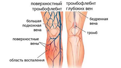 Тромбофлебит – что это такое? Симптомы, причины, лечение тромбофлебита вен  нижних конечностей (глубокий / поверхностный) – Отделение флебологии – НКЦ  №2 (ЦКБ РАН) в Москве