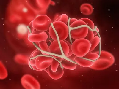 Как распознать тромбоз и тромбофлебит — блог медицинского центра ОН Клиник