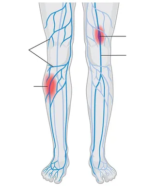 ᐈ Как лечить флебит? ~【Диагностика воспаления вен в Киеве】