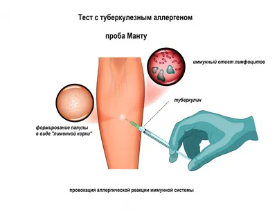 Туберкулез кожи