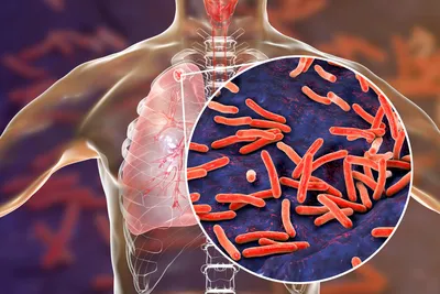 Фтизиатр: Туберкулез влияет на сердце и сосудыForPost - Здоровье |