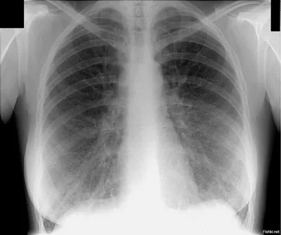Туберкулез и рак легких, как отличить туберкулез от рака лешкого |  Patient-mt.ru