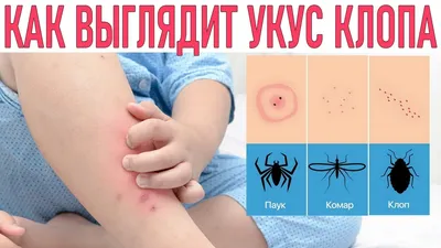 Укусы клопов: Как выглядят укусы клопов фото на теле, мазь, средство