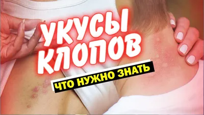 Можно ли определить по фото кто укусил: клоп или комар?» — Яндекс Кью