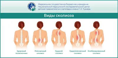 Лечение сколиоза в Екатеринбурге - Кинезиотерапия