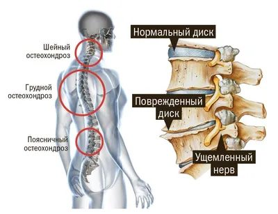 Упражнения при остеохондрозе пояснично-крестцового отдела (ЛФК)