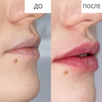 Контурная пластика, увеличение губ филлерами гиалуроновой кислоты в клинике  Медицина для Вас. Фото увеличения губ до и после. Врачи косметологи.
