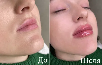 Сторис для косметолога увеличение губ контурная пластика губ эстетика |  Instagram photo, Photo and video, Instagram
