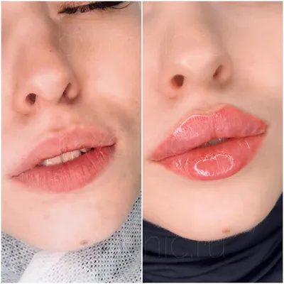Увеличение губ в Севастополе без операции косметология «Водолей»