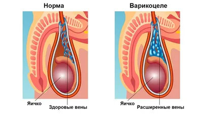 Варикоцеле