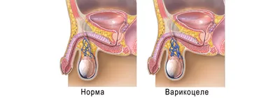 Варикоцеле: причины, симптомы и лечение в Клинике АльтраВита