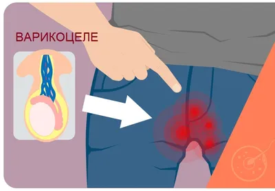 Варикоцеле 2 степени - симптомы, лечение, операция. - Хирург К. В. Пучков