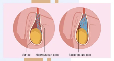 Лечение варикоцеле в СПб | Причины, диагностика, методы, цены