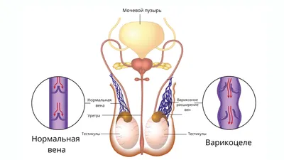 Варикоцеле