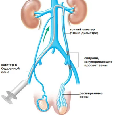 Как лечить варикоцеле яичка