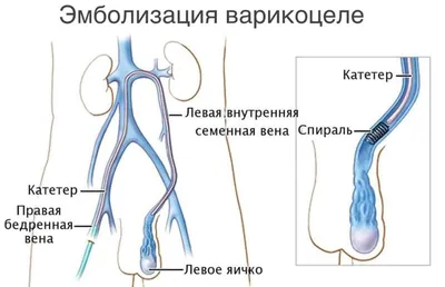 Лечение варикоцеле у мужчин (операция), детей и подростков