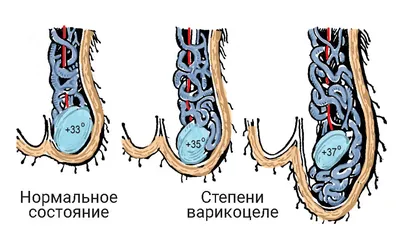 Варикоцеле у мужчин. Опасности, диагностика и лечение. Операция Мармара |  Хирург Щевцов А.Н. - YouTube