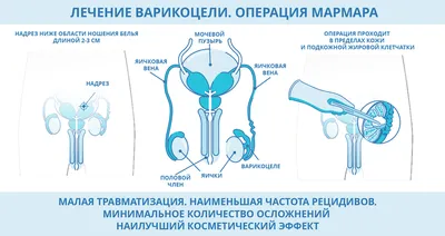 Лечение варикоцеле - цена операции в Санкт-Петербурге