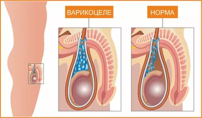 Что такое варикоцеле и как его лечить - все о варикоцеле у мужчин |  «Институт Вен»