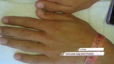 Вирус Коксаки в Украине: В больницах Кривого Рога уже 14 человек