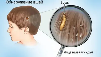 Отличия гнид на волосах от перхоти, как избавиться от педикулеза?