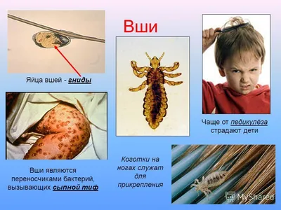 В Роспотребнадзоре назвали районы Екатеринбурга, где больше всего вшей: чем  опасны вши, как понять, что у тебя вши - 27 июля 2023 - Е1.ру