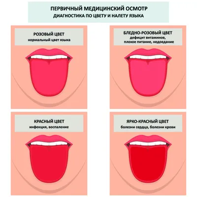 Географический язык - причины появления, при каких заболеваниях возникает,  диагностика и способы лечения