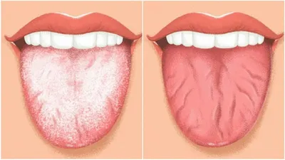Как по языку узнать диабет: о каких болезнях говорят изменения в полости  рта - 13 января 2024 - НГС24.ру