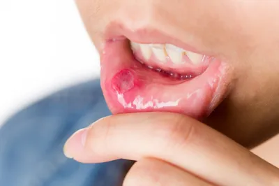 Заболевания полости рта и десен - статья