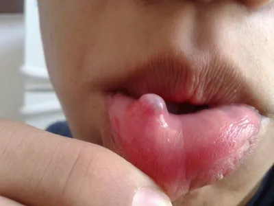 Лечение заболеваний слизистой оболочки полости рта в Кисловодске - клиника  \"Современная стоматология\"