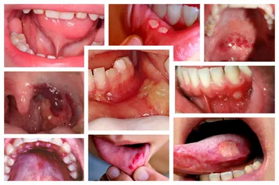 Афтозный стоматит – что это, лечение, виды, причины и симптомы