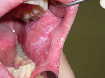 Заболевания полости рта и их возможные неизлечимые последствия. | Dental  Plats - стоматология СПБ | Дзен