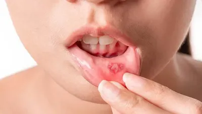 Лечение слизистой оболочки полости рта в Санкт-Петербурге: цены в клинике  ДОКТОР ДЕНТ