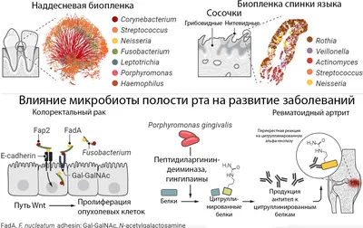 Кандидоз полости рта - причины, симптомы, диагностика, лечение,  профилактика молочницы во рту у детей и взрослых