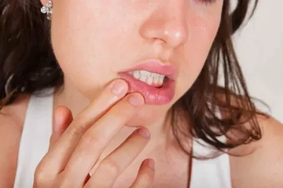 Герпетический стоматит: симптомы, причины и лечение вирусного заболевания  полости рта