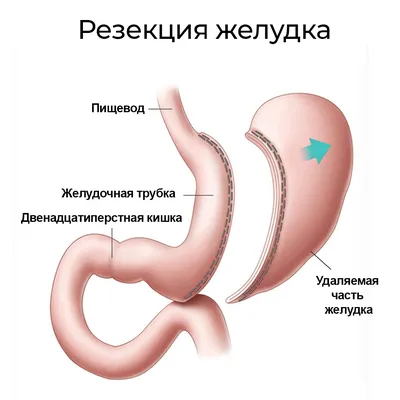 Лечение язвы желудка в Екатеринбурге - Новая больница