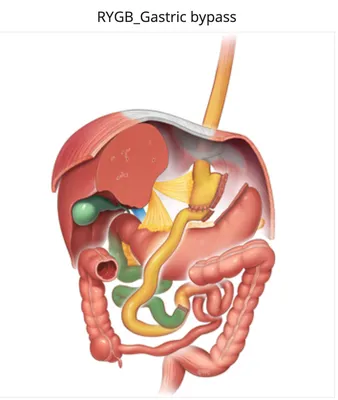 ШУНТИРОВАНИЕ ЖЕЛУДКА GASTRO BY-PASS | Prof. Dr. Serdar KAÇAR | Bariatric  Surgery, General Surgery