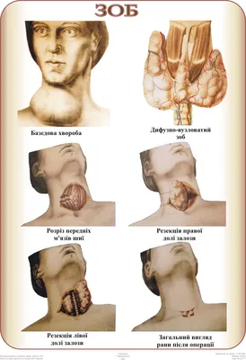 Что такое зоб и в чем опасность этого заболевания - Медицинский центр  Здоровое Поколение (Днепр) - Частная клиника, УЗИ, прививки, вакцинация  БЦЖ, диагностика, лечение, детская поликлиника в Приднепровске, на Тополе,  на Покровском (