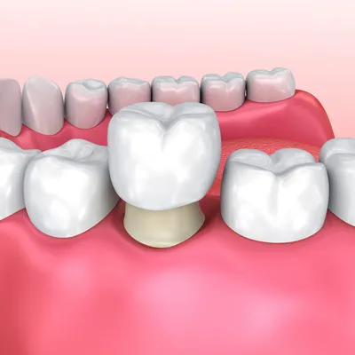 Зубной штифт – что это, виды, плюсы и минусы | Блог | Стоматология «Дент  Тайм»