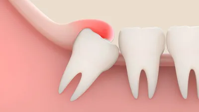 Коронка на зуб — плюсы и минусы по видам, описание, стоимость
