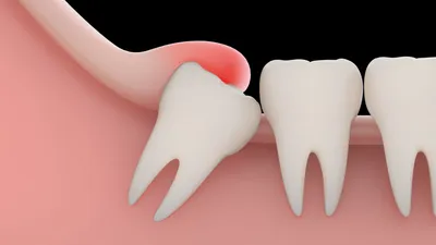 Как выглядит зуб и как корень зуба Альтернативная медицинская клиника