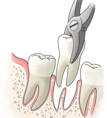 Больной зуб иллюстрация вектора. иллюстрации насчитывающей бело - 47094113