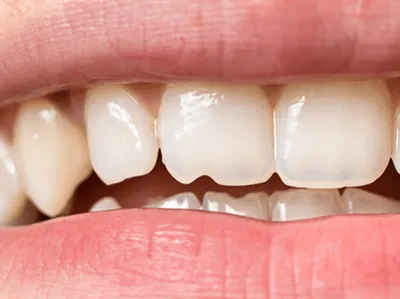 Шатаются зубы у детей и взрослых - почему, что делать, как лечить
